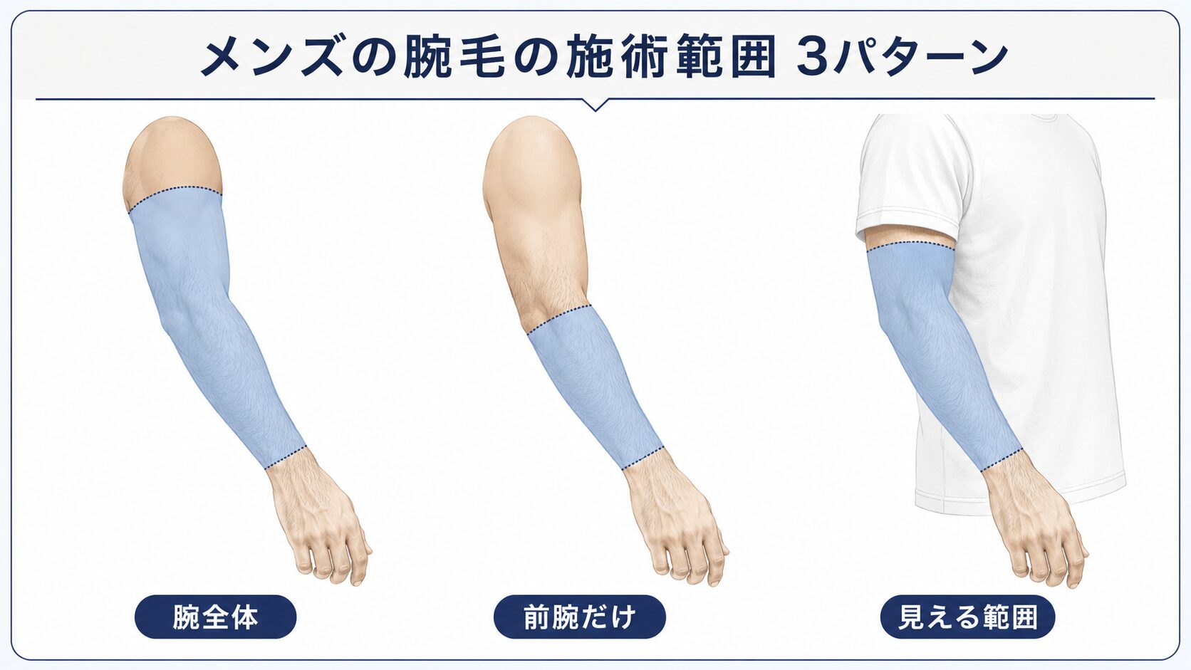腕毛を処理する範囲を腕全体・前腕だけ・半袖から見える範囲の3つに分けた図解